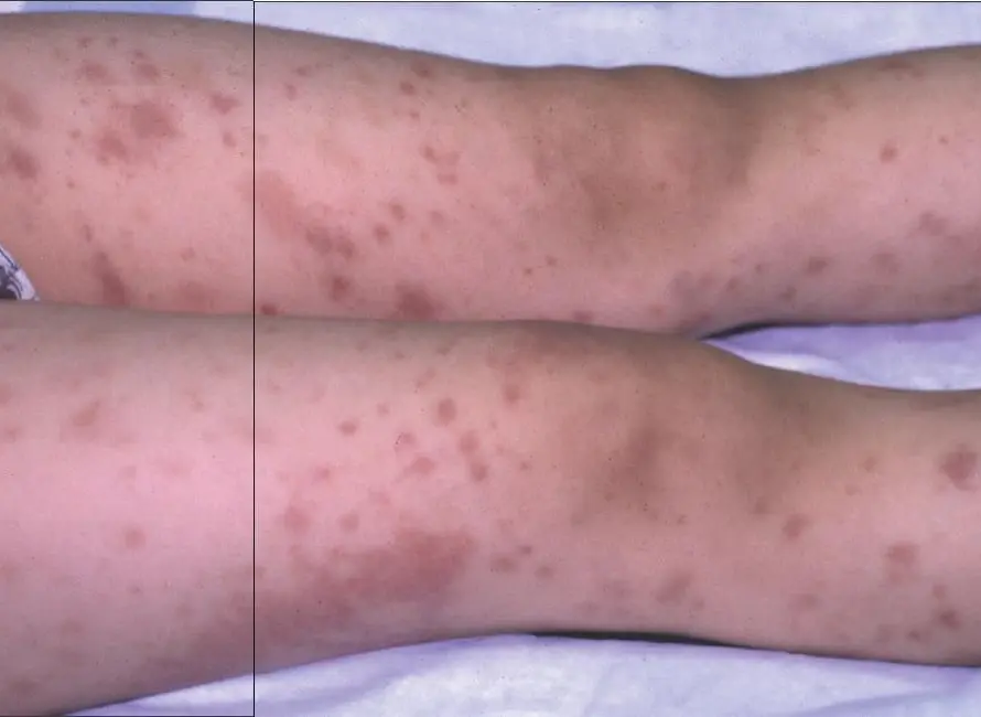 Αγγειίτιδα – φλεγμονή αιμοφόρων αγγείων