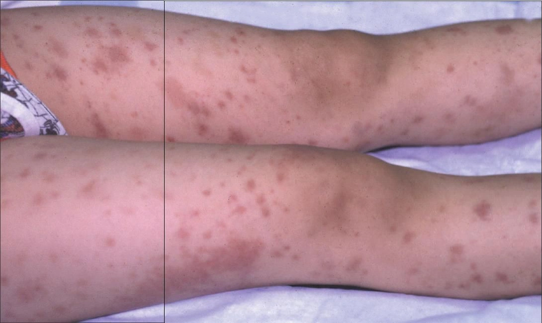 Αγγειίτιδα – φλεγμονή αιμοφόρων αγγείων